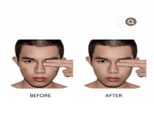 Anti-Acne Organic Facial Wash - For MEN